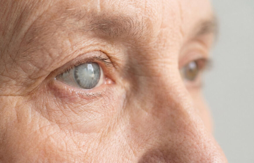 Cataract Surgery